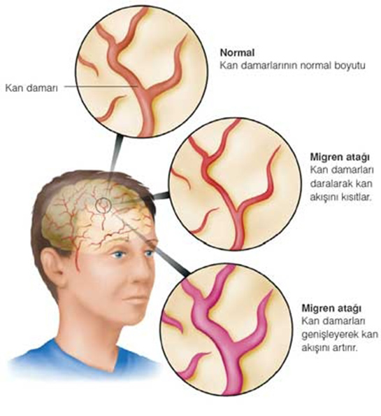Migren Ameliyat